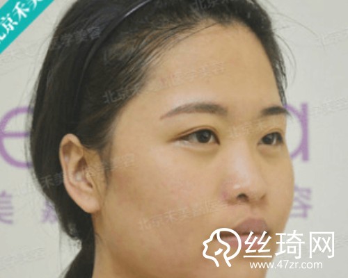 北京禾美嘉醫(yī)療美容自體脂肪填充面部那個(gè)醫(yī)生好？