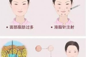在臉上打溶解脂肪針劑多久會(huì)有果