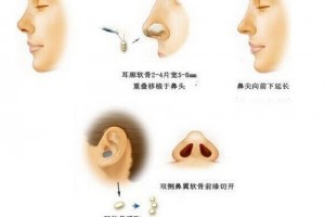 耳軟骨隆鼻能保持多久