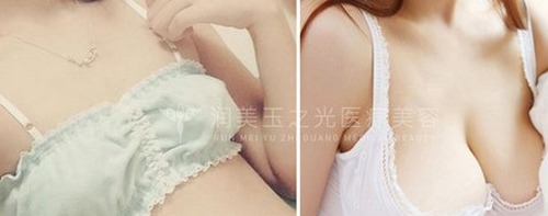北京潤美玉之光自體脂肪豐胸哪個醫(yī)生好