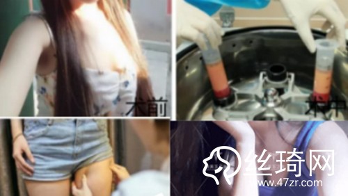 北京潤美玉之光自體脂肪豐胸哪個醫(yī)生好