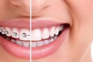 成人做牙齒矯正有危害?牙齒矯正有年齡限制嗎？