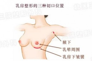 假體隆胸前，我需要做些什么?