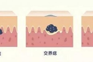 廣州醫(yī)科大學(xué)附屬順德醫(yī)院皮膚科主任余南生告訴你什么樣的痣可以選擇激光祛除