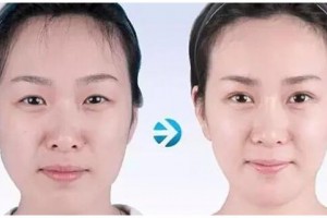 自體脂肪移植豐面部哪些地方，告別面部凹陷