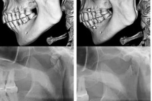 整形科普：可吸收釘板在下頜骨髁突骨折中的應(yīng)用