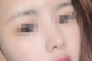 云南瑪麗亞整形美容醫(yī)院做的面部吸脂，原來擁有精致的小臉蛋這么簡單