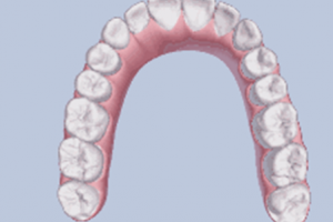 牙齒矯正，要多久? 我32歲可以做矯正嗎？
