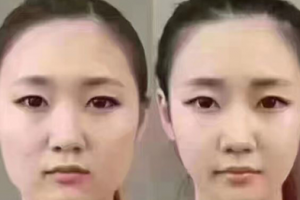 擁有精致小V臉？你只缺一支注射瘦臉注射瘦臉！