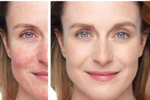 醫(yī)美護膚大課堂之如何祛紅祛痘印