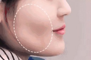 麗都自體脂肪移植，你值得擁有