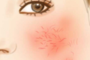 要怎么擺脫紅血絲？臉上有紅血絲的成因時(shí)什么