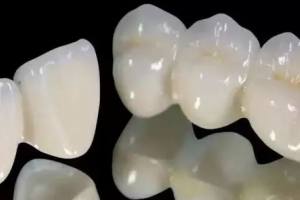 全瓷牙就是烤瓷牙？?jī)烧哂胁顒e嗎？該怎么選擇？