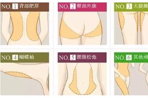 上海天大整形醫(yī)院吸脂果好嗎?上海吸脂減肥要多少錢？