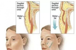 在韓國做去眼袋手術(shù)如何？純真眼底脂肪重排術(shù)價格曝光