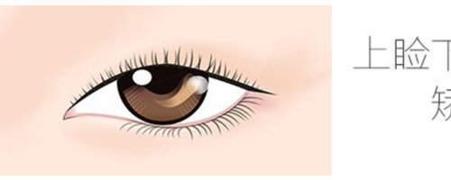 上瞼下垂矯正原理是是什么，上瞼下垂問(wèn)題應(yīng)該如何矯正？