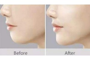 自體脂肪填下巴優(yōu)缺點對比及術(shù)后注意事項