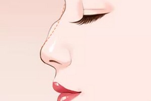 成都駝峰鼻整型價格多少錢