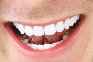 純鈦烤瓷牙多少錢