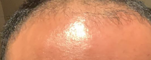 寧波小伙花6萬到杭州新生植發(fā)醫(yī)院種頭發(fā)半年了還禿著