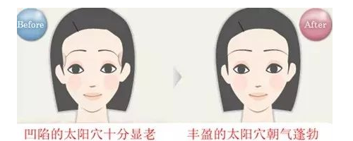 晶馨SG自體脂肪細(xì)胞豐太陽穴，秒變V臉女神不是夢(mèng)！