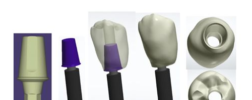 來自美國牙齒種植修復(fù)高端技術(shù)：DOSA