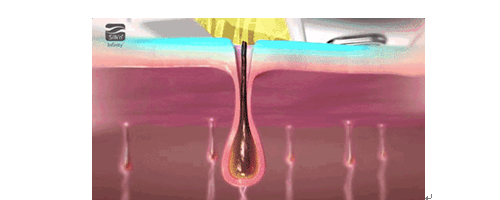 美萊妍學(xué)社做過激光脫毛的你，對(duì)它真的了解嗎？