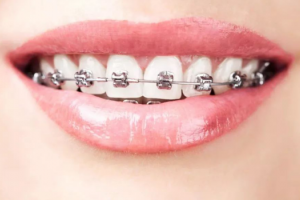 牙齒矯正的注意事項