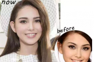 牙齒美白——擁有一口健康亮白的牙齒，笑起來才會(huì)更迷人！