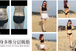 一個(gè)疑思，吸脂減肥真的有用嗎？