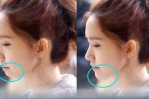 有了下巴，人都美了！面部有輪廓了，氣質(zhì)更好了！