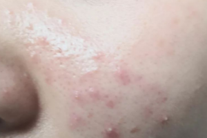 調(diào)節(jié)痘痘為什么不能依靠美容院，化妝品？