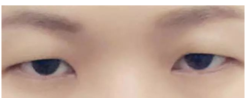 【普賽克】矯正上瞼下垂，get美眼