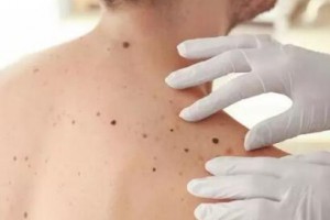 激光激光祛痣，還你肌膚“清白”！