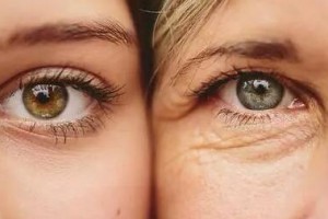 激光去眼袋的優(yōu)點(diǎn)是什么？激光去眼袋有哪些注意事項(xiàng)?