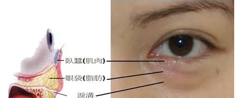 你們可能不知道，淚溝比眼袋丑多了