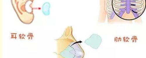 [普及]自體軟骨隆鼻？軟骨來(lái)自身體哪個(gè)部位呢？