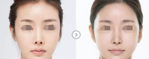 發(fā)際線后退？一招幫你解決！