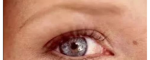 黃褐斑為什么愛反復(fù)？醫(yī)學(xué)博士：祛斑3大金方，排黑素，去褐斑！