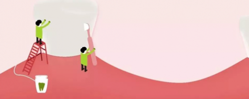 家人不用擔(dān)心我的胃口了！牙齒種植Soeasy！