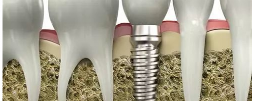 口腔科普：什么是種植牙？
