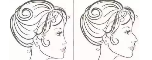 隆鼻N年后會怎么樣？需要再更換嗎？