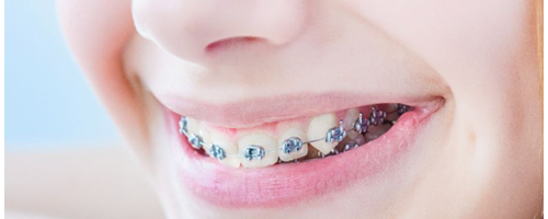 為什么牙齒矯正那么貴？