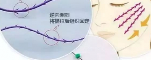 埋線提升+玻尿酸=鋼筋+混凝土