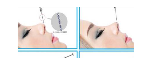 隆鼻要取代假體？感覺有點兒扯