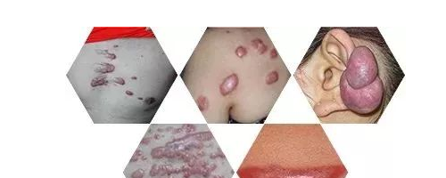 小疙瘩連成疙瘩片，疤痕為什么會越變越大？