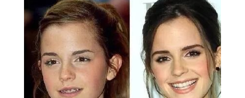 原本健康的牙齒需要拔掉進行矯正嗎?