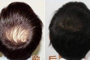 無錫坤如瑪麗醫(yī)院植發(fā)怎么樣附全新價格表(價目表)