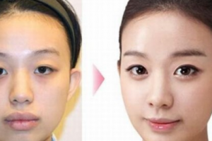 福州雍禾植發(fā)怎么樣附全新價(jià)格表(價(jià)目表)