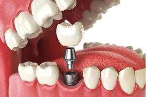 2020沈陽(yáng)市口腔醫(yī)院整形價(jià)格表(價(jià)目表)全新發(fā)布